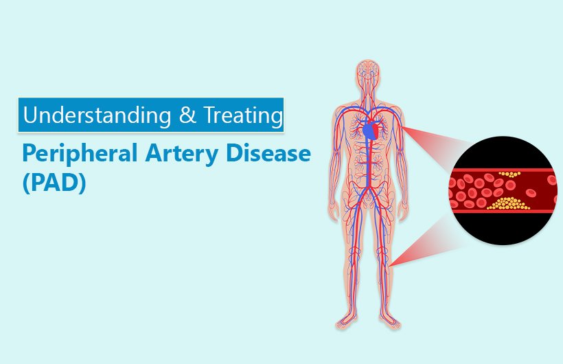 understanding and treating peripheral artery disease