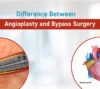 angioplasty and bypass surgery