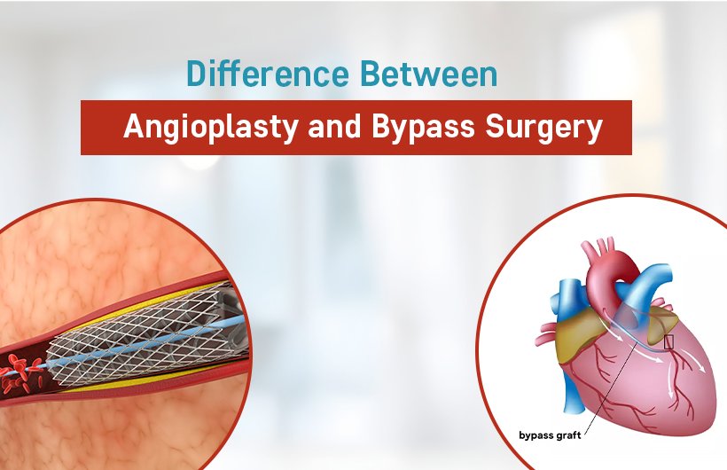 angioplasty and bypass surgery