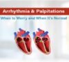 arrhythmia & palpitations